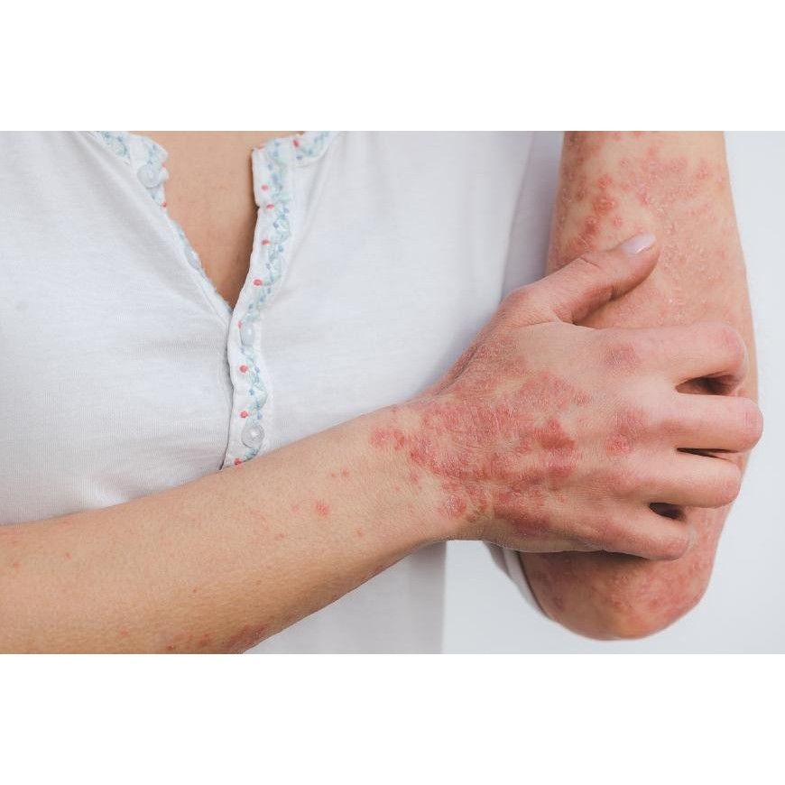 Le CBD et le psoriasis, quelle efficacité ?
